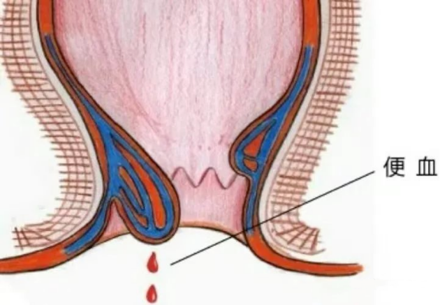 保定東大肛腸醫(yī)院丨肛腸疾病不都是痔瘡的“鍋”，這些疾病都不能忽視！
