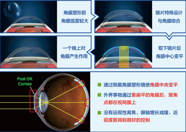 合肥愛爾眼科：角膜塑形鏡只要戴上就行？你想簡單了！