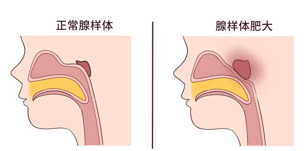 娃睡覺張嘴？越長越丑？成都民生耳鼻喉醫(yī)院：很多小孩都被腺樣體肥大困擾