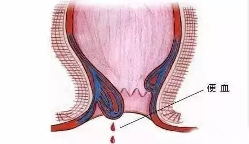 保定東大肛腸醫(yī)院丨肛腸疾病千萬別硬抗，這六種癥狀一定要去醫(yī)院！