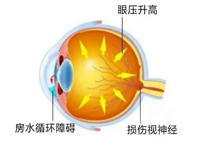 【合肥愛爾】青光眼嚴重嗎？它可能會致盲！