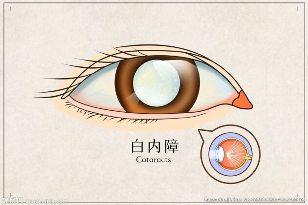 眼前好像蒙了一層霧，是白內(nèi)障嗎？這5大癥狀，轉(zhuǎn)發(fā)給父母自查——福州愛爾