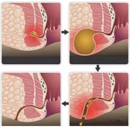 保定東大肛腸醫(yī)院看肛腸疾病怎么樣？這種高發(fā)的肛門疾病發(fā)病率僅次于痔瘡，卻幾乎無法自愈！