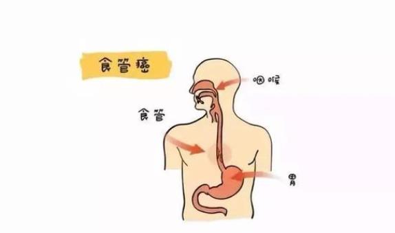 如何預防食道癌 食道癌吃什么食物好