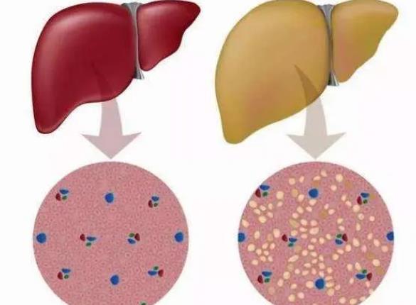 脂肪肝能治好嗎 脂肪肝不能吃什么