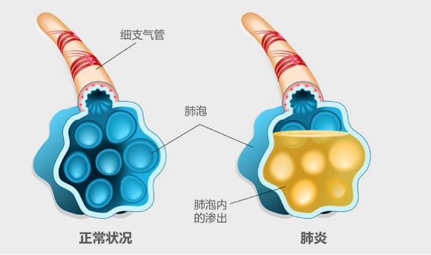 流感疫苗可以預(yù)防肺炎嗎 ？支原體肺炎更易侵襲小學(xué)生嗎？