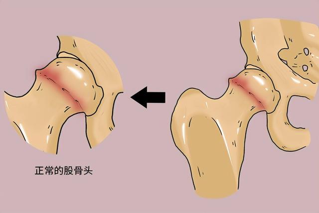 股骨頭壞死平常怎么養(yǎng)？專家推薦天然中成藥