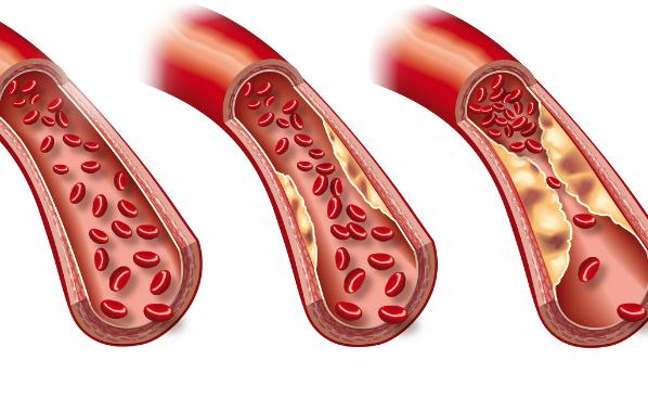 高血脂的癥狀有哪些 ？高血脂會(huì)引起高血壓嗎？