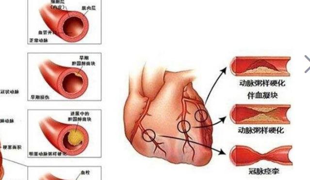 冠心病吃什么好？治療冠心病要多少錢？