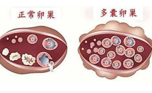 樣預(yù)防多囊卵巢？多囊為什么肚子大？