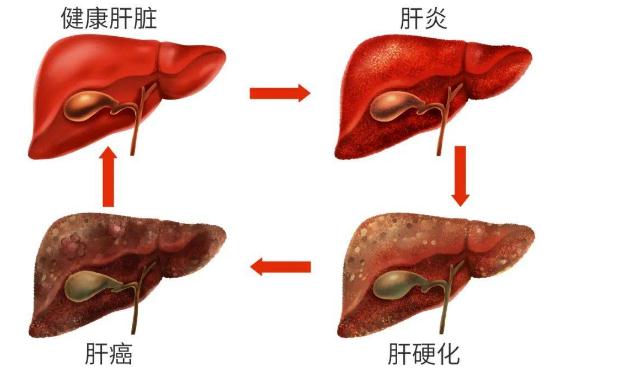 丁型肝炎有什么危害呢？丁型肝炎的癥狀有什么呢？