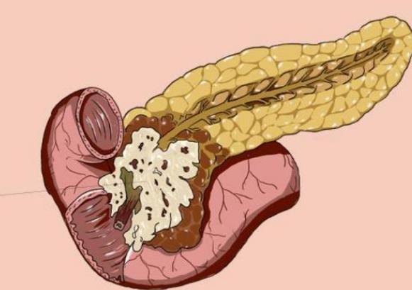 胰腺癌的病因是什么 胰腺癌能治好嗎