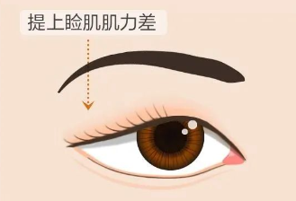 合肥愛(ài)爾專家科普：上瞼下垂＝眼皮松弛？其實(shí)真相是……