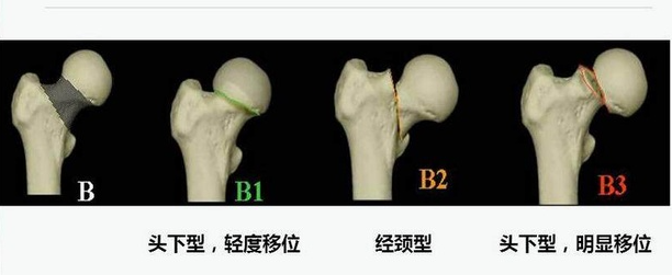 股骨頭壞死早期有效治愈方法迎來全新進展，中成藥將是關鍵