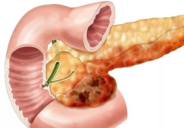 胰腺炎為什么不能喝水？狗狗胰腺炎能治好嗎？