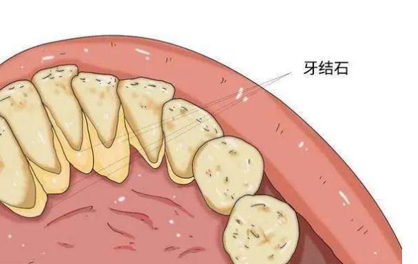 牙周炎可以用沖牙器嗎 ？牙周炎吃什么好？