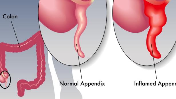 闌尾炎會遺傳嗎 闌尾炎的病因是什么