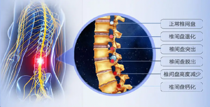 腰椎間盤突出久治不愈，快來試試仙濟(jì)玉靈貼！