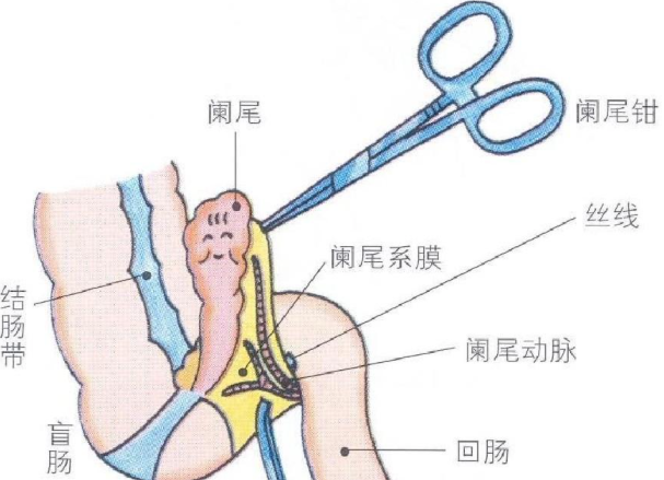 闌尾炎會(huì)死亡嗎 闌尾炎怎么辦