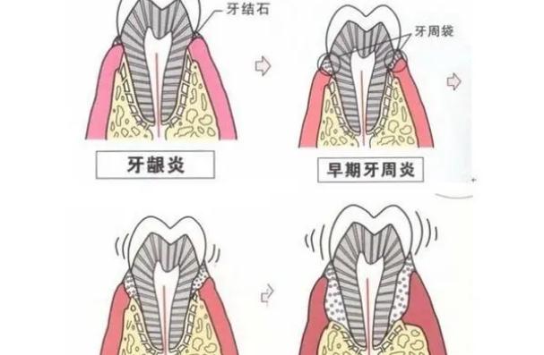 牙周炎會癌變嗎？牙周炎會病變嗎？