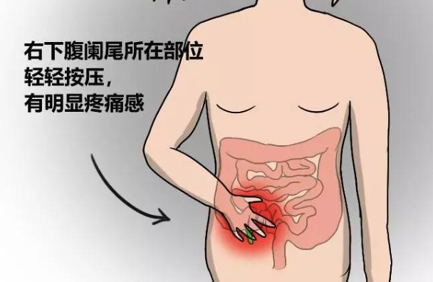 慢性闌尾炎可以喝酒嗎 加重癥狀致穿孔彌漫性腹膜炎