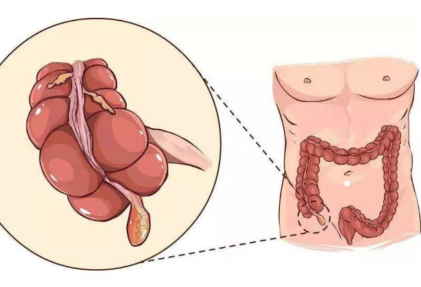 急性闌尾炎腹痛有哪些特點 闌尾炎除了痛還有什么表現(xiàn)