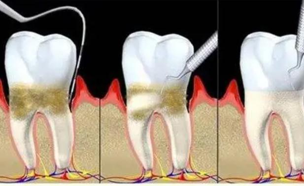 牙周炎跟腎虛有關(guān)系嗎？牙周炎跟上火有關(guān)系嗎？