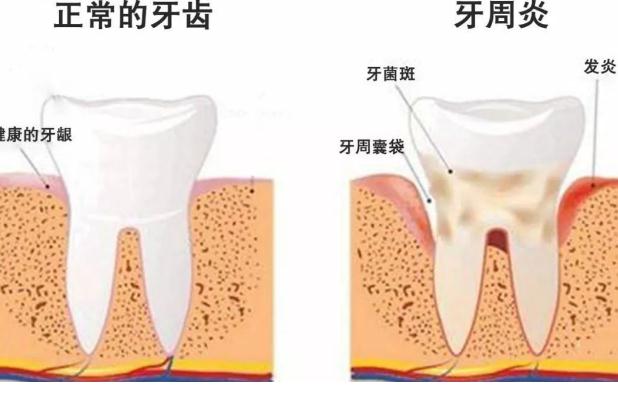 牙周炎檢查？牙周炎小偏方？