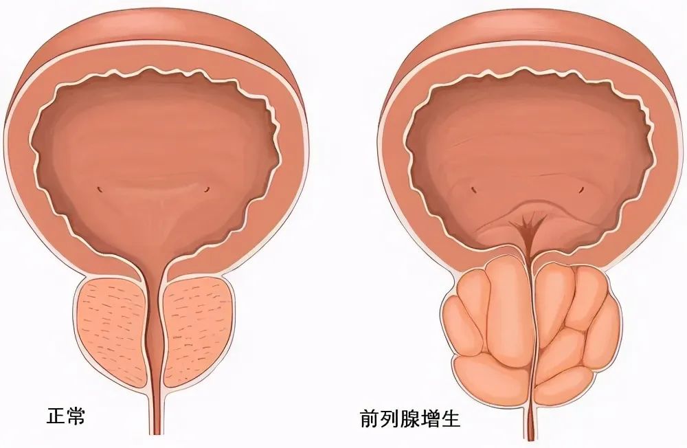 103度水蒸氣“熱死”前列腺病灶Rezūm瑞夢(mèng)輕松解決中老年男性前列腺增生問(wèn)題