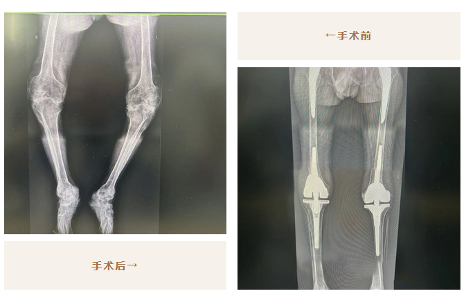 太厲害了！我院骨科助力26年不能站立的他，重新行走！