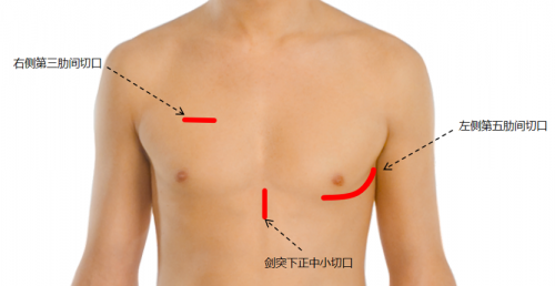 重大突破！福建首創(chuàng)長(zhǎng)期人工心臟微創(chuàng)植入術(shù)