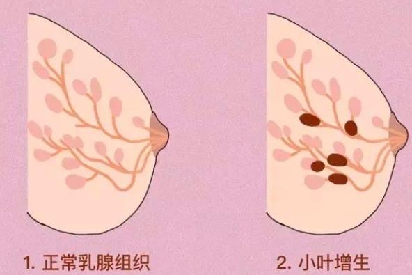 內(nèi)分泌絮亂會導(dǎo)致乳腺增生嗎 乳腺增生腋窩里會疼嗎