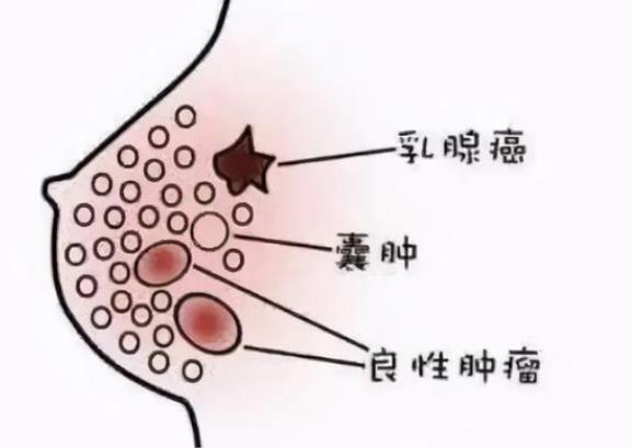 乳腺結節(jié)能懷孕嗎 乳腺結節(jié)變大怎么回事