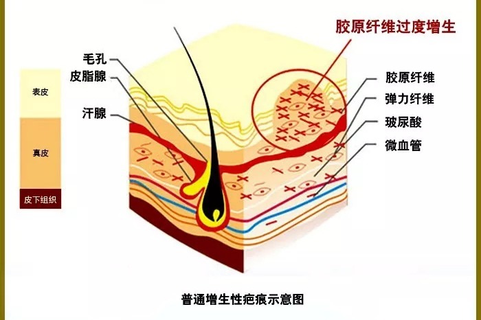 【沈陽(yáng)膚康疤痕科普】之紋身疤痕，紋身雖美，疤痕防治不可忽視