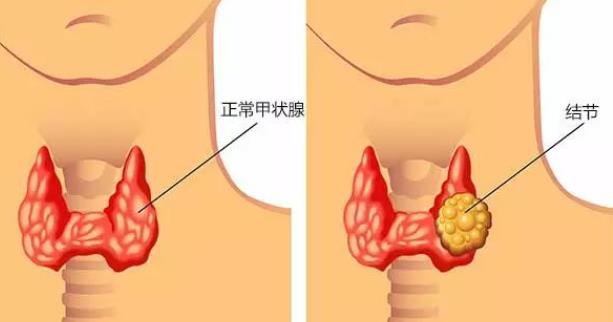 玻璃結(jié)節(jié)肺部是癌癥嗎 結(jié)節(jié)距離癌癥有多遠