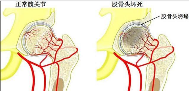 慎用激素藥！激素導(dǎo)致股骨頭壞死不要怕，通血生骨方純中藥調(diào)理，從根源治療！