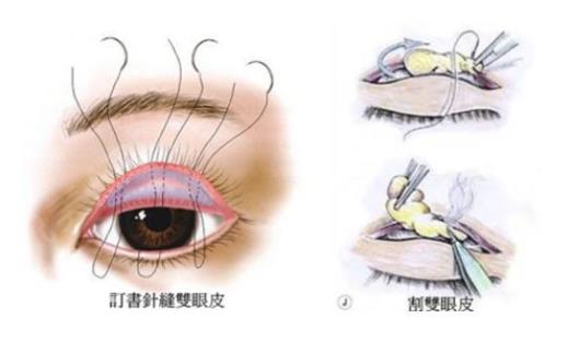 雙眼皮修復(fù)寬改窄好容易嗎 雙眼皮寬改窄修復(fù)多少錢