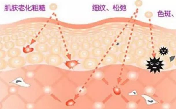 敏感肌可以做光子嫩膚嗎 光子治療紅血絲有效嗎