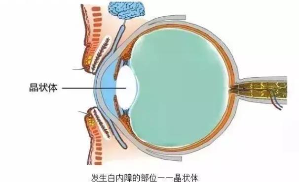 白內(nèi)障術(shù)后多久恢復(fù) 白內(nèi)障手術(shù)后多久可以運(yùn)動