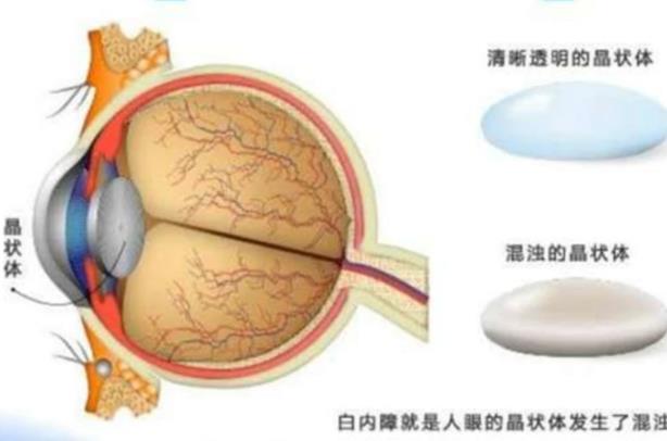 白內(nèi)障有哪些并發(fā)癥 視力色覺(jué)改變青光眼失明