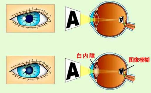 白內(nèi)障嚴(yán)重了會怎么樣 眩光色覺屈光改變眼睛敏感度視力下降