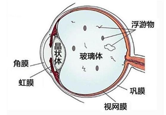 飛蚊癥有哪些表現(xiàn) 有飄動(dòng)小黑影視物模糊視力下降眼痛