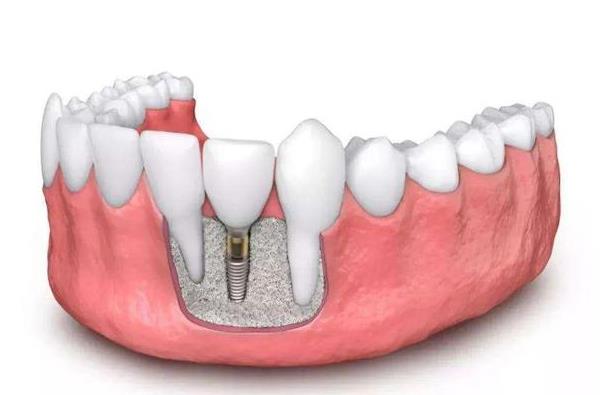 種植牙后多久可以懷孕 種植牙可以洗牙嗎
