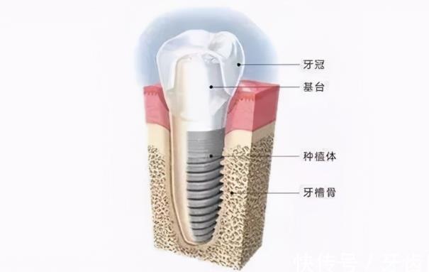 種植牙出血正常嗎 種植牙會(huì)長(zhǎng)嗎