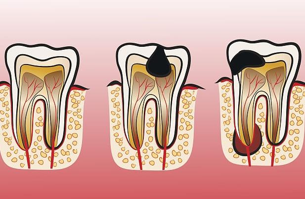 為什么會(huì)急性牙髓炎 急性牙髓炎怎么消炎