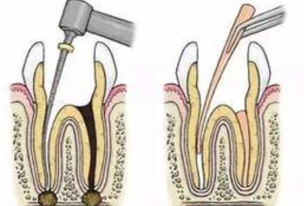 牙髓炎保髓治療復發(fā)怎么辦 牙髓炎保髓成功率是多少