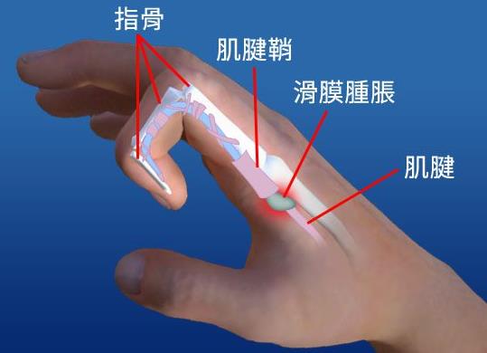 長時間玩手機(jī)容易得腱鞘炎嗎 腱鞘炎都有哪些癥狀