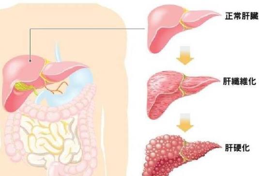 肝硬化是怎么回事 肝硬化有哪些癥狀