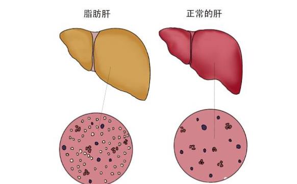 瘦人也會得脂肪肝嗎 脂肪肝的病因是什么