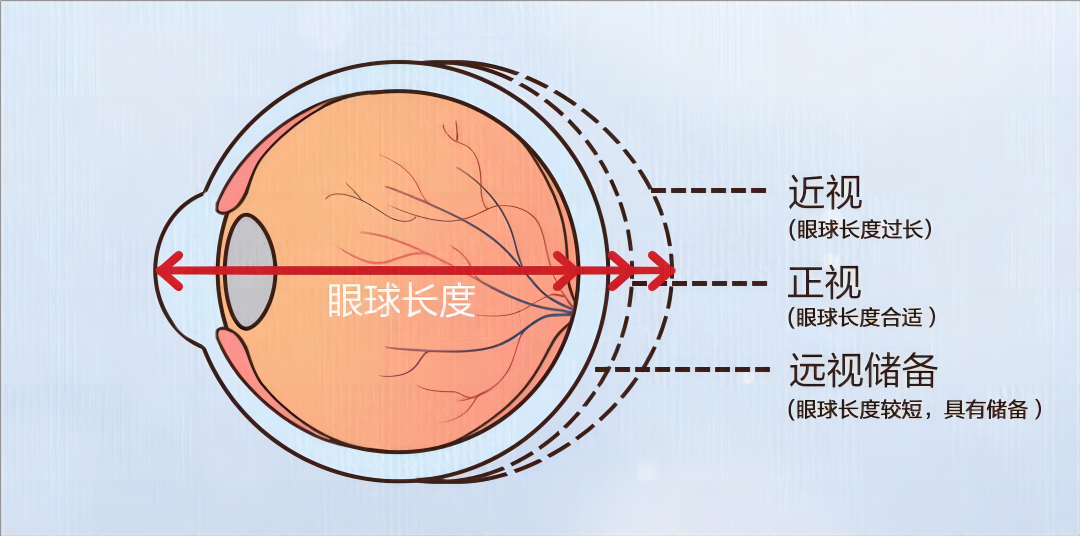 合肥愛(ài)爾眼科陳國(guó)府醫(yī)生深度揭秘：近視可逆嗎？